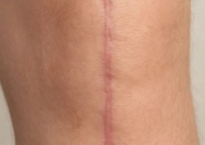 knee scar