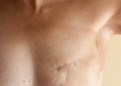 breast scar